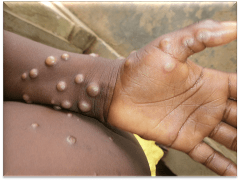 World Health Organisation working closely with countries responding to monkeypox
