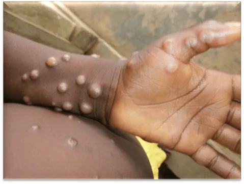 World Health Organisation working closely with countries responding to monkeypox